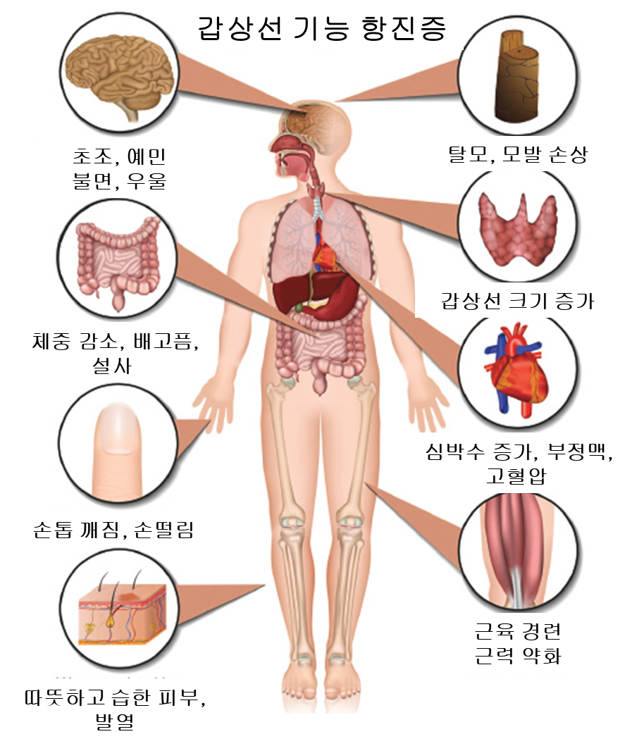 내분비내과 의사가 말하는 갑상선기능항진증의 증상